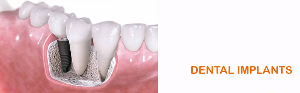 Dental Implants Vs Dental Bridges