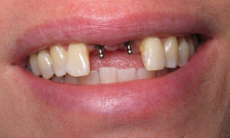 Mini-dental-implants