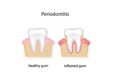 danger of periodontitis