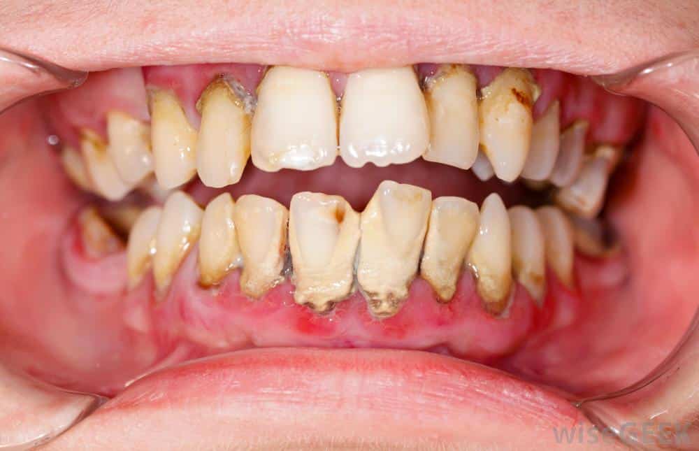 Tooth decay ABC Dental