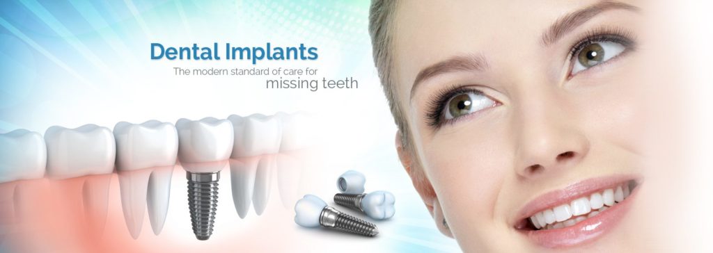 implant is the ideal solution