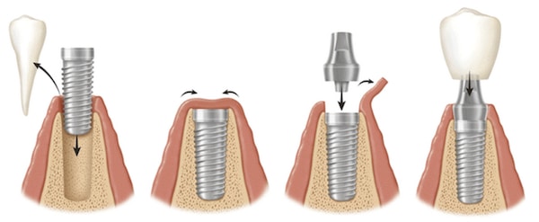 Dental Implant Procedure Cover