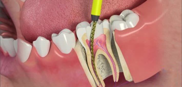 Effectiveness of Root Canal Therapy