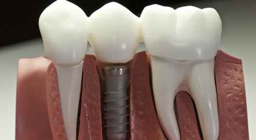 A_Permanent_Tooth_Restoration_Solution