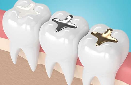 img-COMPOSITE-FILLINGS