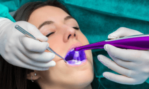 dental-sealants-keller