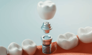 Fort-Worth-Dental-Implants-Treatment