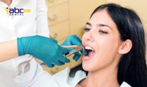Cavity-tooth-extraction