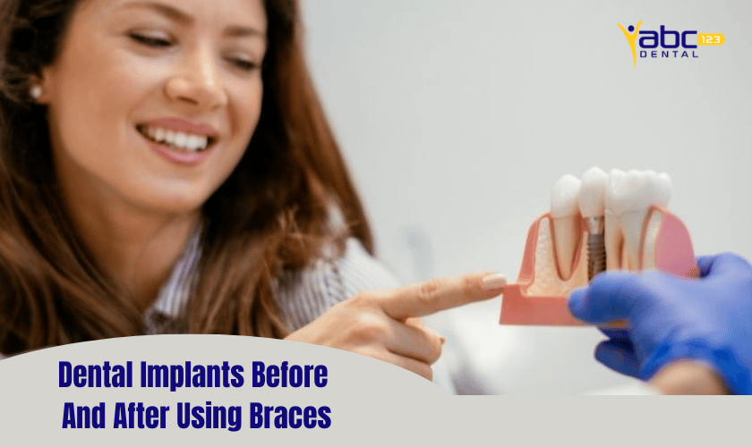Dental Implants Before And After Using Braces
