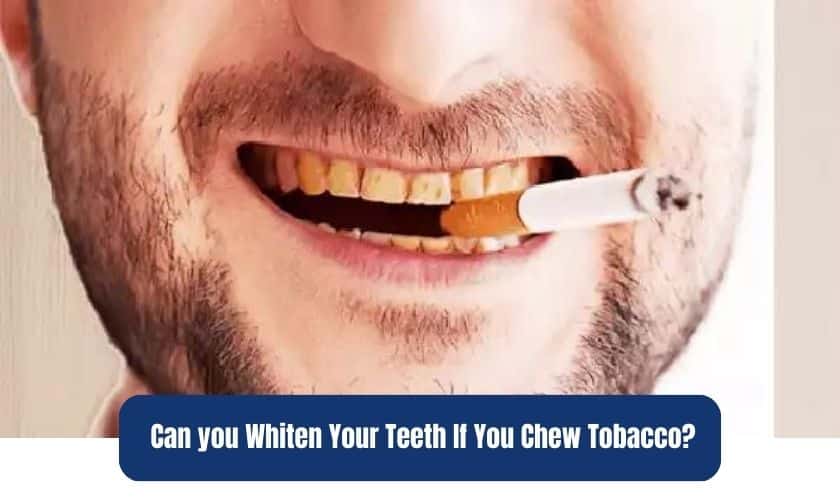 Are you a tobacco chewer looking to whiten your teeth? Professional teeth whitening is usually the best option for chewers due to its effectiveness in removing tar and nicotine stains. Learn more about teeth whitening treatments, home remedies, and best practices to help you get your teeth white again.