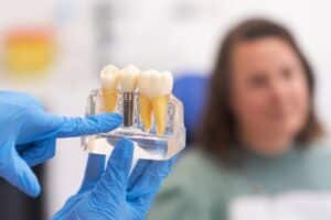 single tooth dental implants in haltom city