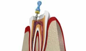 success rate of root canal therapy