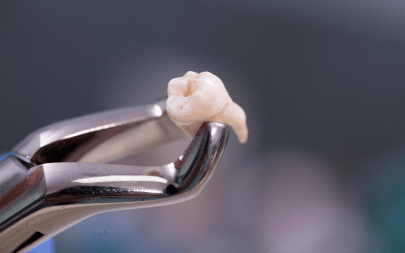 Common Reasons For Tooth Extractions