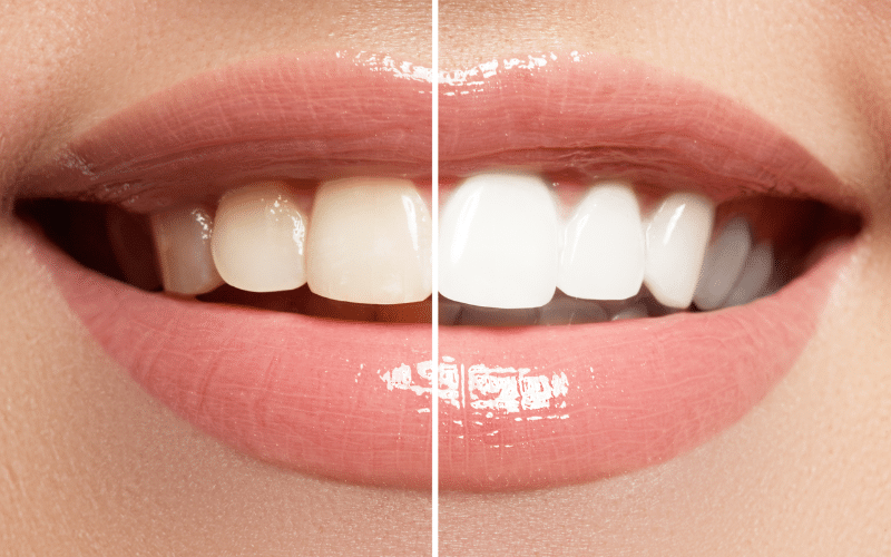 How Diet Impacts Teeth Bleaching Results