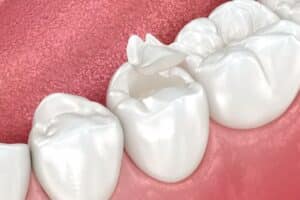 the step-by-step process of getting tooth sealants