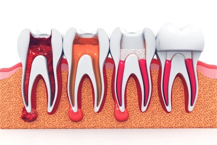 ways root canal treatment saves your original tooth