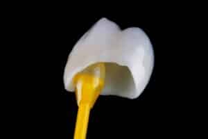 how you can achieve a natural look with front tooth crowns