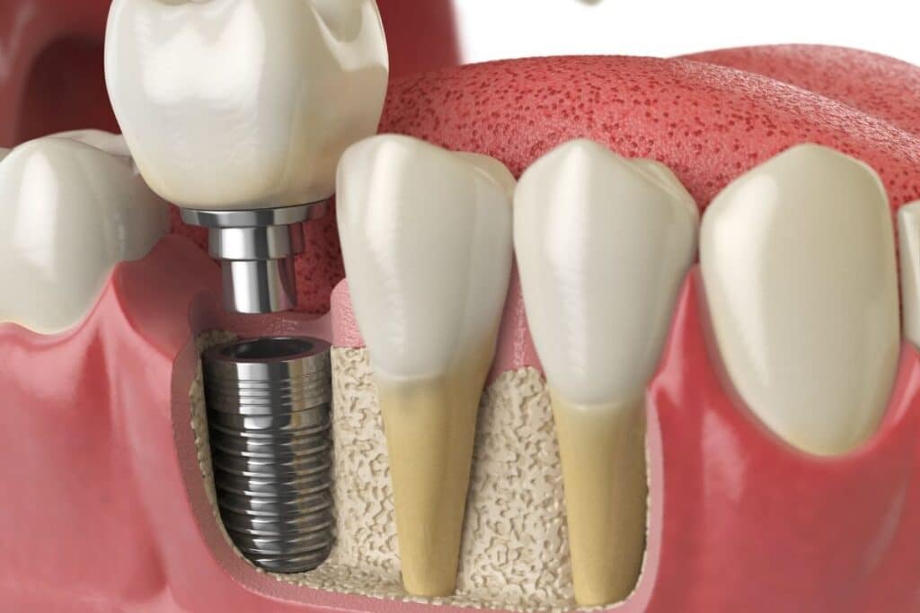Dental-Implants-in-Haltom-City-TX
