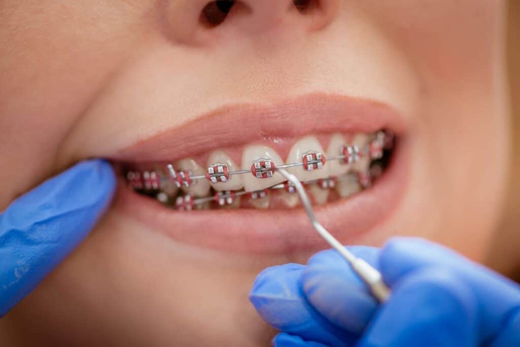 Dental Bridges in Blue Mound