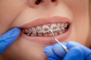 Dental Bridges in Blue Mound